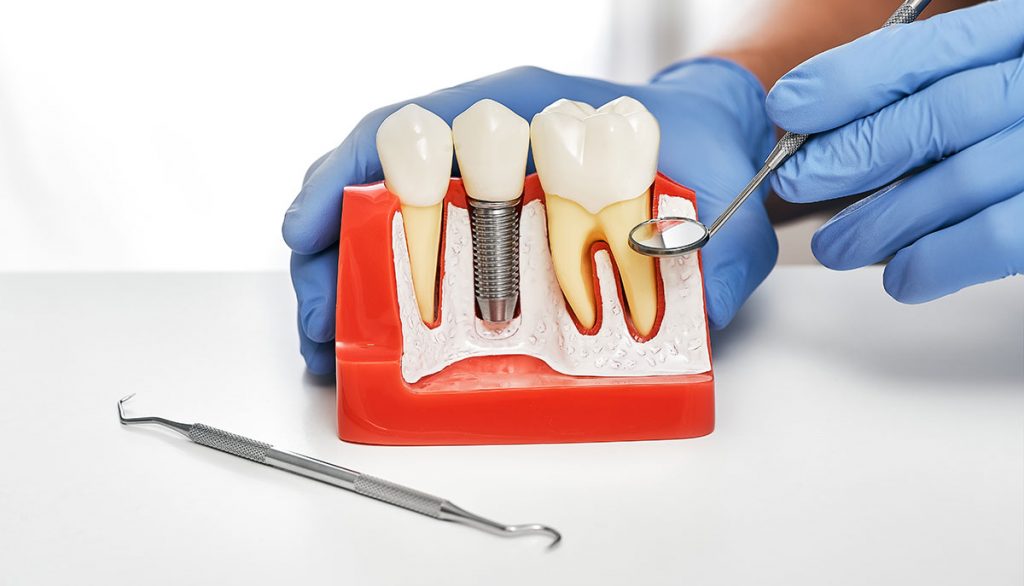 StudioDentisticoPisano_Implantologia_a_carico_immediato
